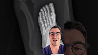 5th metatarsal base fracture  check it out [upl. by Bradford]