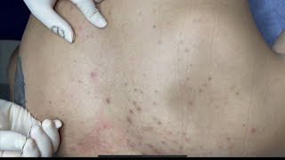 ACNE TREATMENT WITH VU QUYNH MI  Acne Squeeze on Back [upl. by Hube]