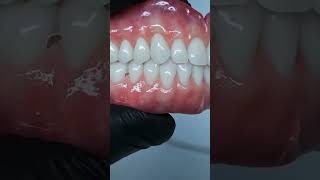 Denture occlusal viralvideo satisfying dentalcare dentist dentistryworld dentalworld dental [upl. by Graehme]