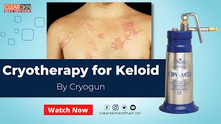 Cryo Therapy For Keloid Scar  Keloid Scars Removal Treatment  DrNKailash Specialist  Kurnool [upl. by Zeuqirdor]