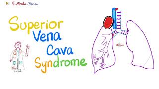 Superior Vena Cava SVC Syndrome  Pancoast Tumor  Pathology  Oncology  5MinuteReview [upl. by Ahsinik]