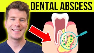 Doctor explains DENTAL ABSCESS tooth abscess  Causes symptoms amp treatment [upl. by Aluin]