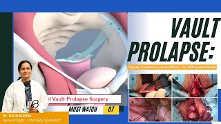 Vault Prolapse Unveiled Causes Solutions and Its Impact on Women’s Health  Dr BKN Sudha’s Guide [upl. by Elie]