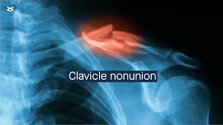 Clavicle nonunion management and considerations [upl. by Naimerej]