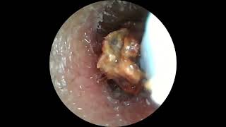 Insane Ear Wax Removal with Camera Tool [upl. by Naor]