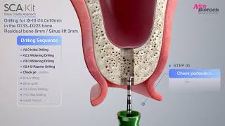 SCA Kit｜Sinus lift Crestal approach with bone graft｜Procedure Neobiotech [upl. by Geiger7]