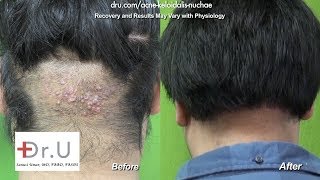 barbers rash back of head Acne Keloidalis Nuchae AKN cure [upl. by Ivers]