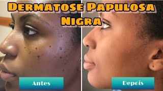 DERMATOSE PAPULOSA NIGRA TRATAMENTO VERRUGAS ll RESULTADOS EM 1 SEMANA COM FOTOS [upl. by Ibok454]