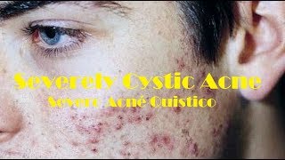 Cystic acne become severely inflamed and infected  Severo Acné quistico [upl. by Orin]