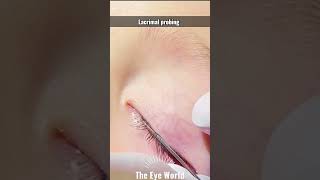 lacrimal probing in children [upl. by Aniroz803]