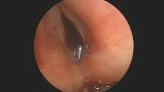 Example of Dynamic 3Phase Rigid Laryngotracheobronchoscopy [upl. by Irrej833]