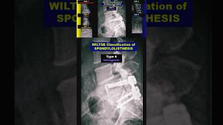 Spondylolisthesis  Wiltse Classification radiology bones spine xray [upl. by Wobniar89]