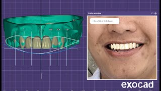 Exocad Mockup and Waxup Model creator [upl. by Aissyla599]