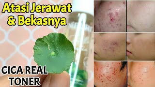 Review Toner Npure  Toner Terbaik Untuk Jerawat  Toner Untuk Jerawat  Cara Cepat Atasi Jerawat [upl. by Verlee]