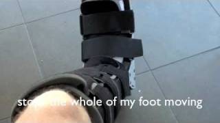 Stress Fracture 2nd Metatarsal [upl. by Ginnifer544]