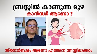 സ്തനത്തിൽ കാണുന്ന മുഴ കാൻസർ ആണോ  Breast Cancer Malayalam  Dr Narayanankutty Warrier [upl. by Yrreiht]