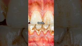 Gingivitis vs periodontistiswhats the difference [upl. by Chiles]