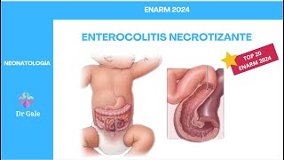 NEONATOLOGÍA  ENTEROCOLITIS NECROTIZANTE  ENARM 2024 [upl. by Fanchet]