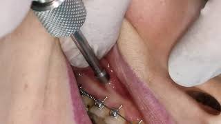 Mini screw mini implant insertion  screwing in orthodontic miniimplant TAD [upl. by Larrisa]