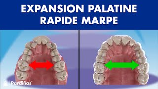 Expansion palatine rapide MARPE  DISJONCTEUR ORTHODONTIQUE chez ladulte © [upl. by Converse]