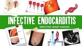 Infective Endocarditis  Dukes criteria  definition causes symptoms complications amp treatment [upl. by Senga]