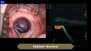 Automated Lamellar Therapeutic Keratoplasty ALTK [upl. by Ainessey]