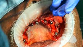 Palatal approachnaso maxillary butresspterygoid to avoid zygomatic implants for atrophic maxilla3 [upl. by Gnouh]