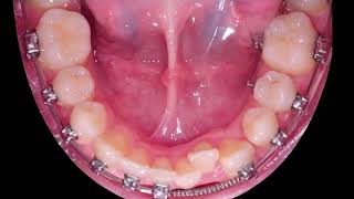 Braces process transformation [upl. by Hanan]