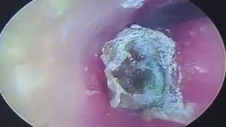 Fungal Ear Infection Cleaning earwax Cleaning earwaxremoval satisfying lullaby relieveanxiety [upl. by Kunkle]