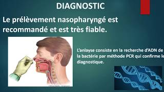 Coqueluche sur enfant de 4 ans symptômes  diagnostics  traitements [upl. by Rriocard17]