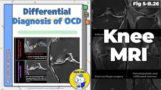 Fig 5B26 Differential Diagnosis of Osteochondritis Dissecans [upl. by Benge435]