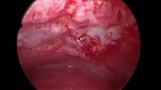 Rigid Thoracoscopy  Pleural Biopsy  Talc Poudrage  Malignant Pleural effusion [upl. by Aronoff541]