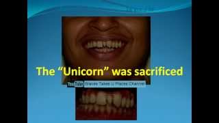 Extra tooth between front teeth  Fixed braces amp no teeth removed [upl. by Wareing]