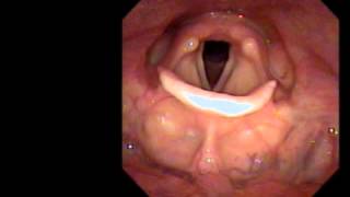 Normal laryngoscopy [upl. by Araed]