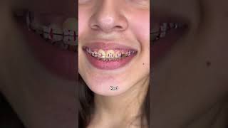 Braces Colors Before and after 8 weeks [upl. by Zondra]