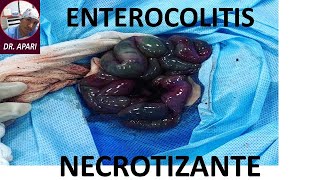 ENTEROCOLITIS NECROTIZANTE NEC  DR APARI 👨‍⚕️ PARTE 1 [upl. by Elwaine]