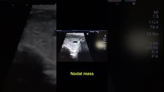 Neoplastic nodal mass shows increased vascularity [upl. by Ninahs]