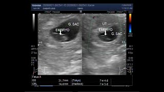 Ultrasound Video showing Fetal demise in early pregnancy of about 08 weeks [upl. by Ro]