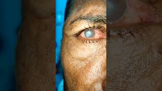 Fungal corneal ulcer eye disease [upl. by Gnehs]