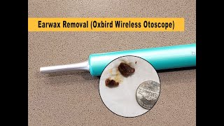 Earwax removal Oxbird Wireless Otoscope [upl. by Neellek144]