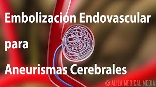 Embolización Endovascular para Aneurismas Cerebrales Alila Medical Media Español [upl. by Atinyl]