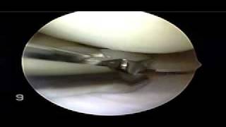 Meniscectomy  Meniscus Tear Knee Surgery [upl. by Zales697]