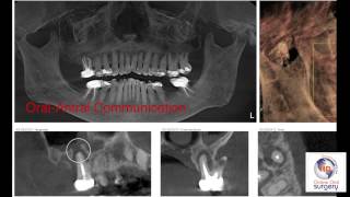 Extraction of Tooth 3 Closure of OralAntral Fistulam4v [upl. by Etnovert]