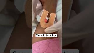 IV cannula preparation legMLTsolutions [upl. by Eliseo]