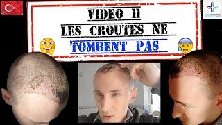 Mes croûtes ne tombent pas  Ma greffe de cheveux FUE 11 [upl. by Bourque866]