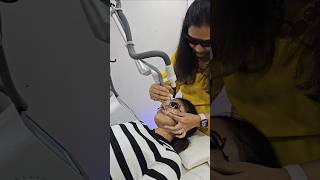 Laser Treatment for Acne Scars  acne shorts [upl. by Kahcztiy397]