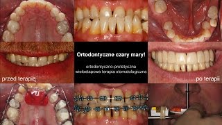 Ortodontycznoprotetyczna wieloetapowa terapia stomatologiczna [upl. by Rockafellow971]