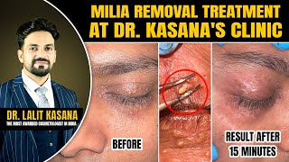 Milia Removal Treatment at DrKasanas Clinic  MILIA Removal Extraction  Before and after [upl. by Oralia]