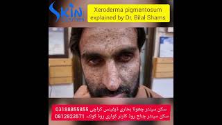 Xeroderma pigmentosum  skin cancer  best dermatologist  Dr Syed Bilal Shams skincenterpakistan [upl. by Augustina]