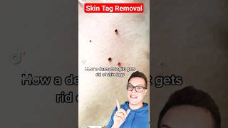 Amazing SKIN TAG REMOVAL  How Dermatologists Do It shorts [upl. by Abran]